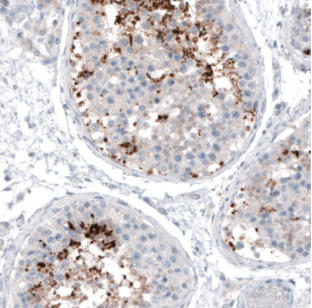 重磅消息—Atlas高品质PrecisA CT83单克隆抗体被T-cure Bioscience用于KK-LC-1肿瘤的I期临床研究